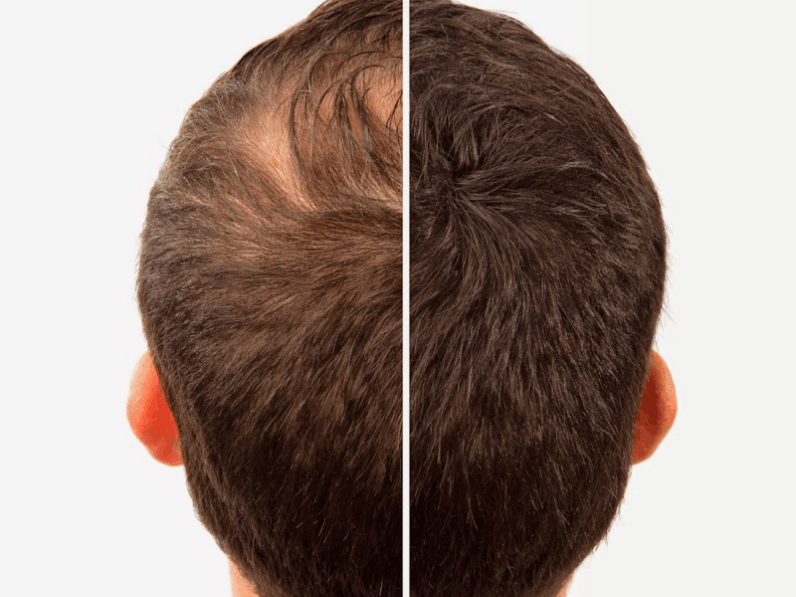Hair transplant by Egypt In-Touch in Hurghada